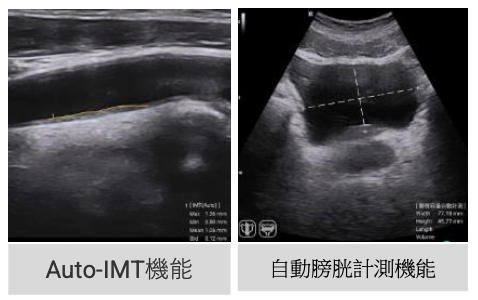 Auto-IMT機能と自動膀胱計測機能の画像
